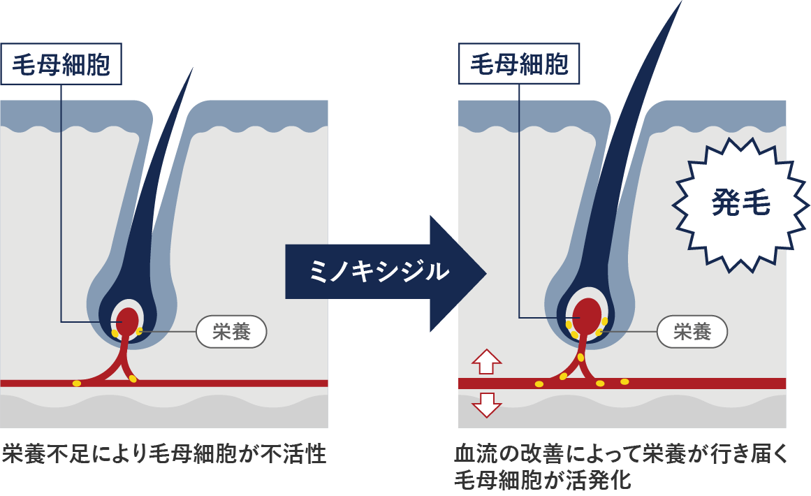 毛髪に栄養を届けることで発毛を促す