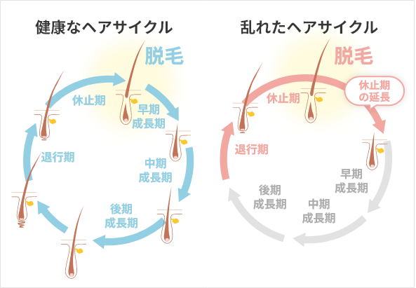 健康なヘアサイクル 乱れたヘアサイクル